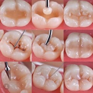 teeth grinding solution